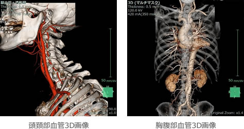 頭頚部血管3D、腹部血管3D画像
